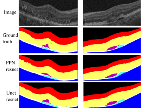 Segmenting OCT images: identifying retinal layers and areas with fluid