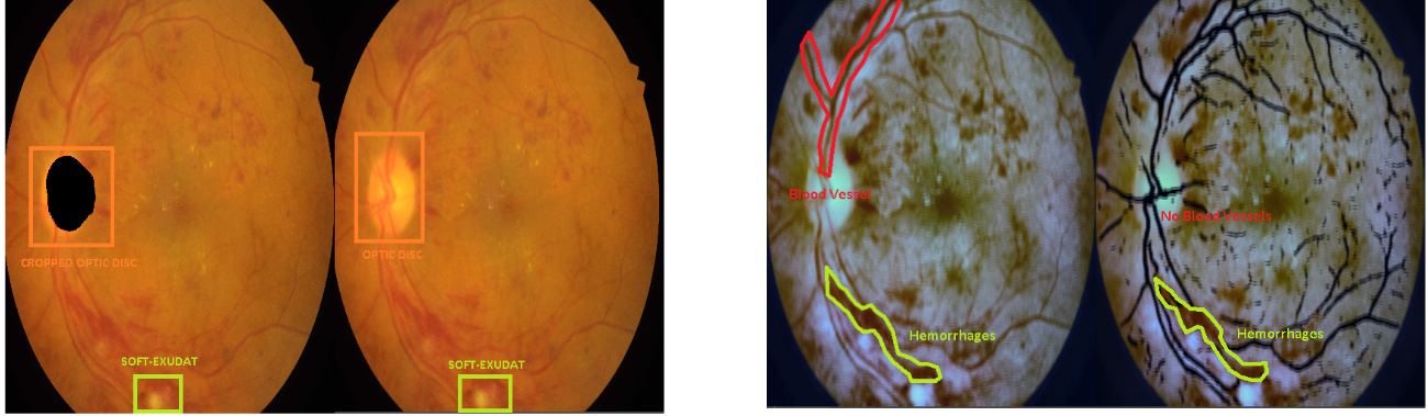 Processing fundus images: removing the optical disk and blood vessels