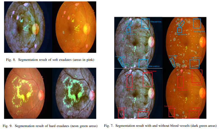 Indetifying biomarkers: hard exudates sau soft exudates 