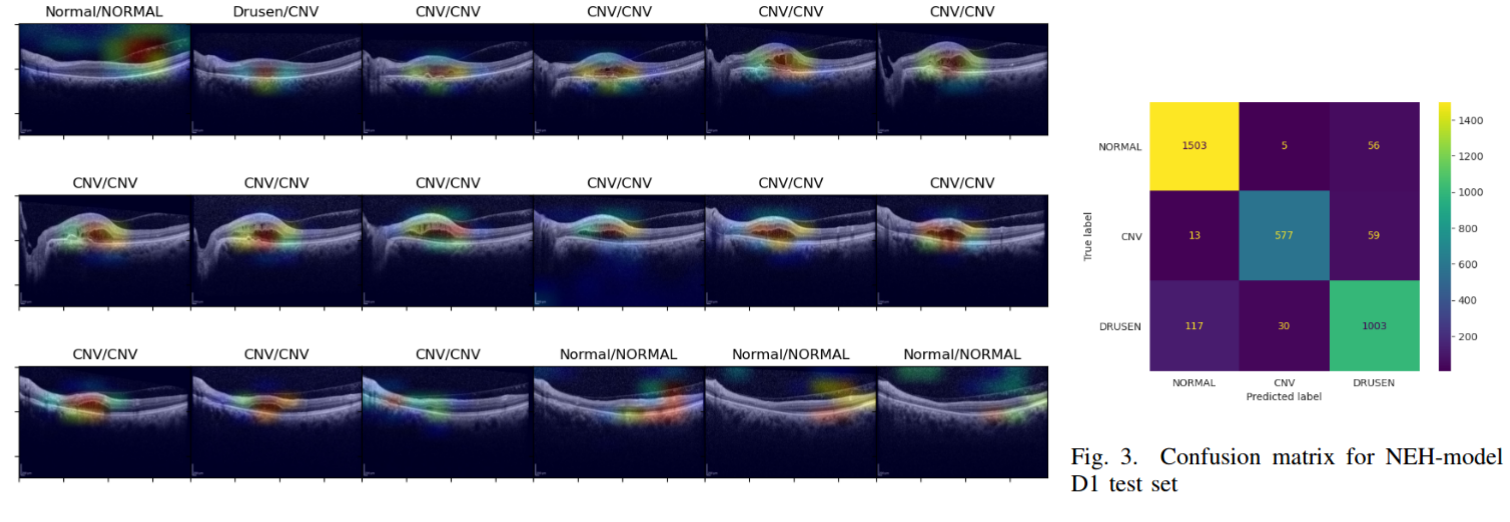 Grad-CAM visualization of a model for a patient with CNV